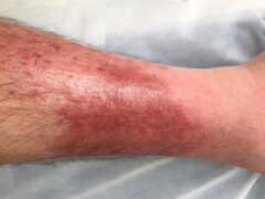 Cellulitis