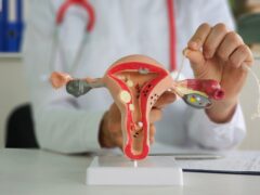 Tubal ligation