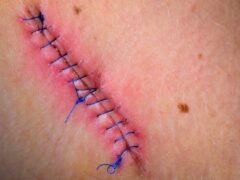 Stitched up wound after surgery
