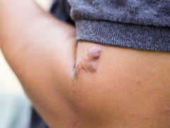 Scar on the boy​ hand,scar on human skin.
