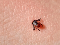 Sucking tick Macro photo on human skin. Ixodes ricinus. Bloated parasite bitten into pink irritated epidermis. Small red drops. Dangerous insect mite. Encephalitis, Lyme disease infection.