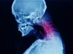 Lateral cervical spine x-ray showing spondylosis with kyphotic deformity of cervical spine. Chin to chest deformity. It cause neck pain, spondylotic myelopathy and radiculopathy.