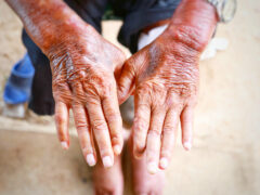 Skin disorder, pepper appearance from scleroderma, autoimmune disease male hand Skin disorder pepper appearance from vitiligo,scleroderma raynaud, medical concept autoimmune disease. Skin disorder,