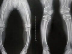 The x-ray of Rickets disease from hypophosphate is shown varus deformity and widening medial physis of bone. The other show improved alignment after the epiphysiodesis of both femurs and tibias.