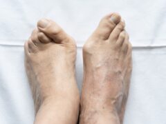 Feet of senior man together with big bunions and hammer toes on the floor. Medical surgery, health care, podiatrist, dermatology concepts
