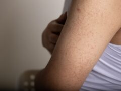 Keratosis Pilaris a harmless skin condition that causes dry, rough patches and tiny bumps, often on the upper arms