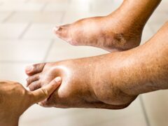 Close-up of an older Asian person with swollen feet, leg vein thrombosis, discomfort or numbness in the ankle, varicose vein issue, elderly person with diabetes, kidney or liver disease, and edema or
