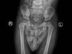 Pediatric pelvis X-ray radiograph showing bilateral hip dysplasia, developmental hip abnormality, femoral heads, acetabulum, and pelvic bones. Medical diagnostic imaging for congenital hip disorder.